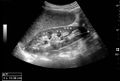 Normal adult kidney - local.jpg