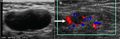 Ultrasonography of a suspected malignant lymph node, with Doppler.jpg