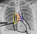 Optimal central venous catheter tip location.jpg