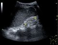 Ultrasonography of end-stage chronic kidney disease - local.jpg