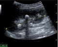 Ultrasonography of centrally-located stone with posterior shadowing - local.jpg