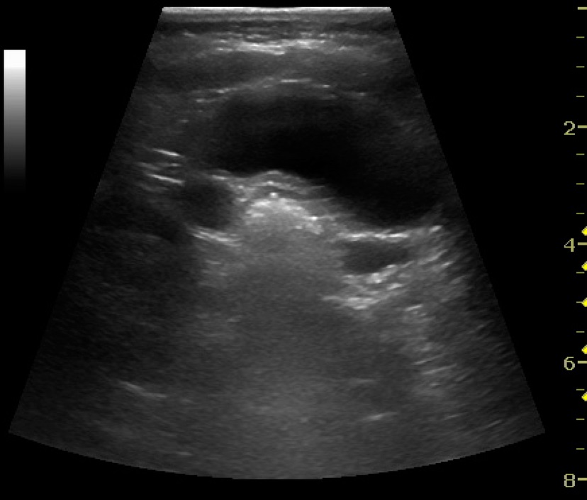 Ultrasonography of the urinary system/Local | Radlines